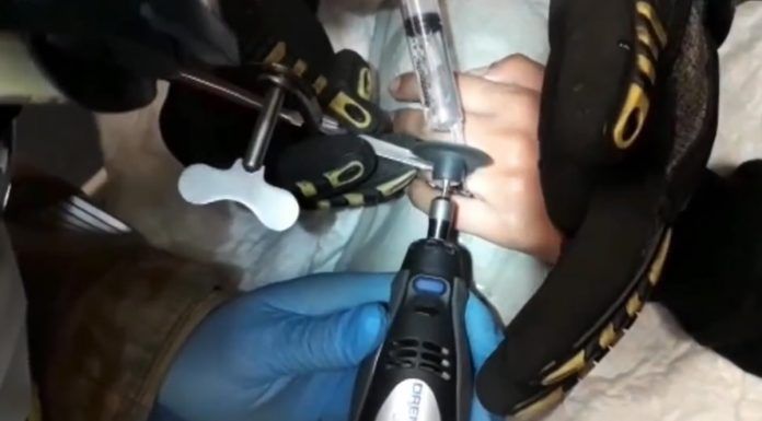 Impresionante intervención de los Bomberos para quitarle un anillo atascado a una joven de Alcorcón